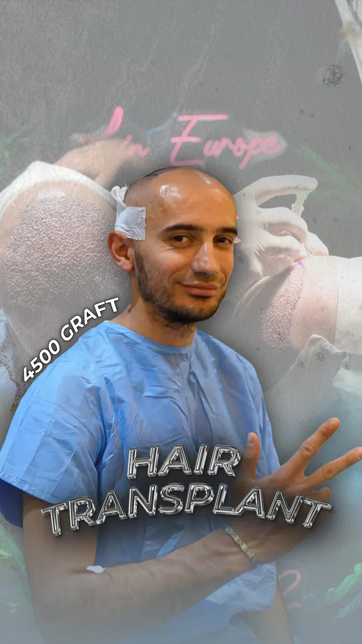Hair Transplant