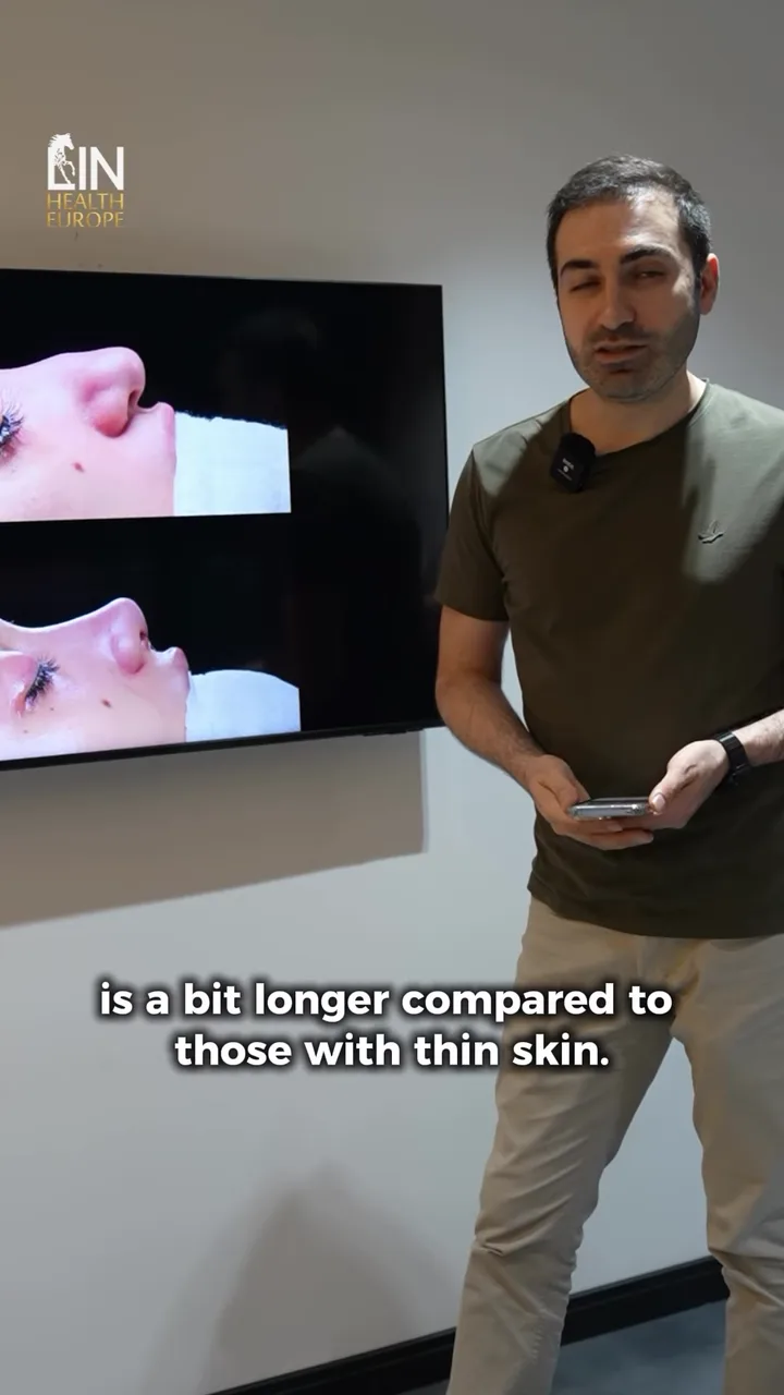 One rhinoplasty, explained