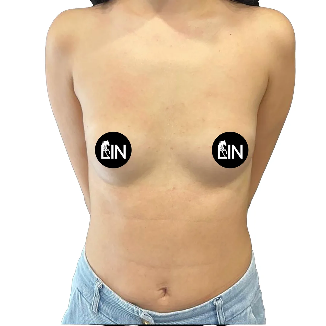 Breast Surgery · Front — Before