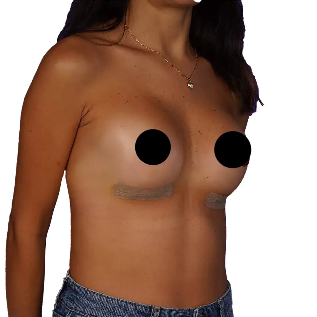 Breast Surgery — After