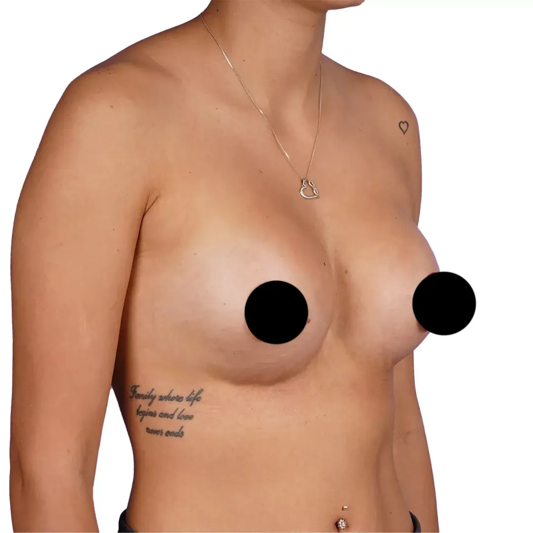 Breast Surgery — After