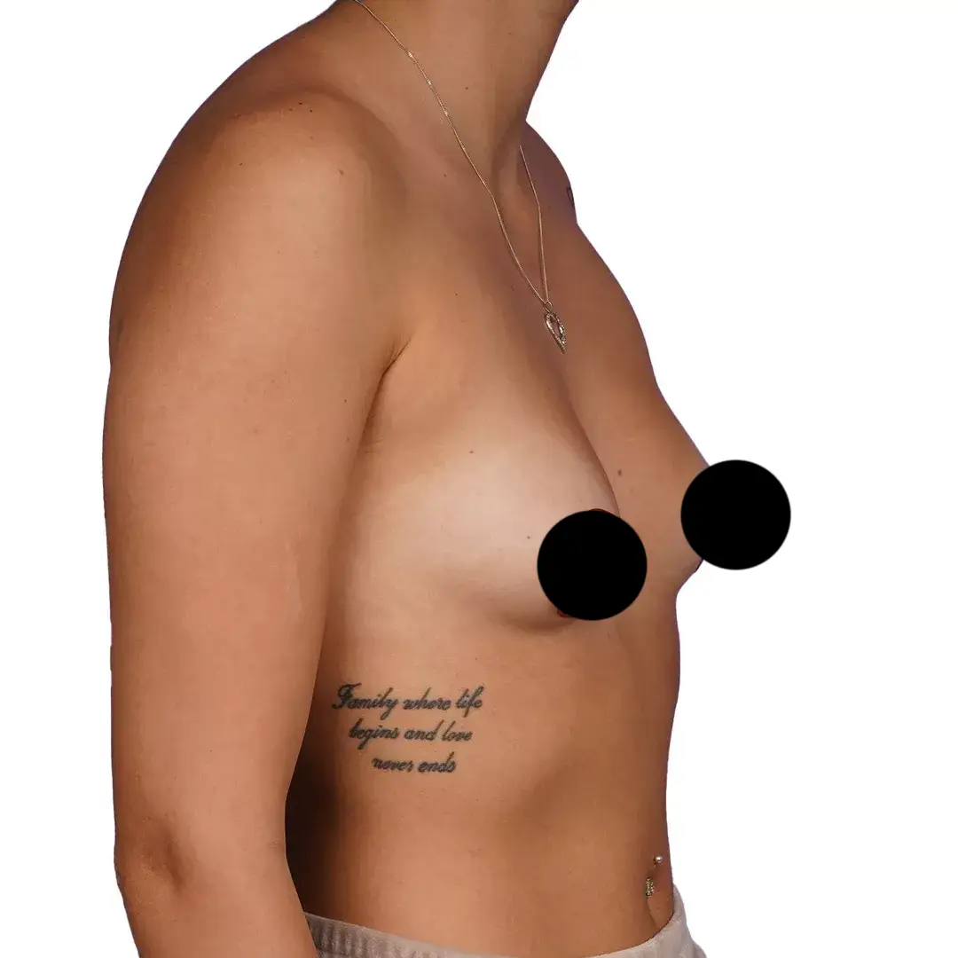Breast Surgery — Before