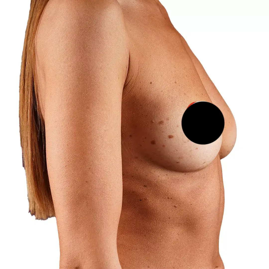 Breast Surgery — Before