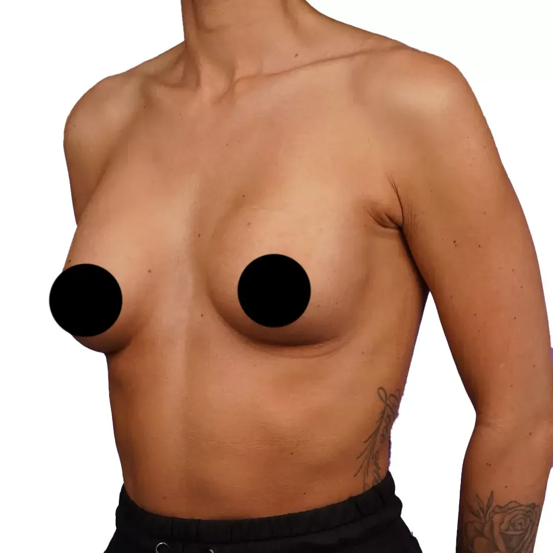 Breast Surgery — Before