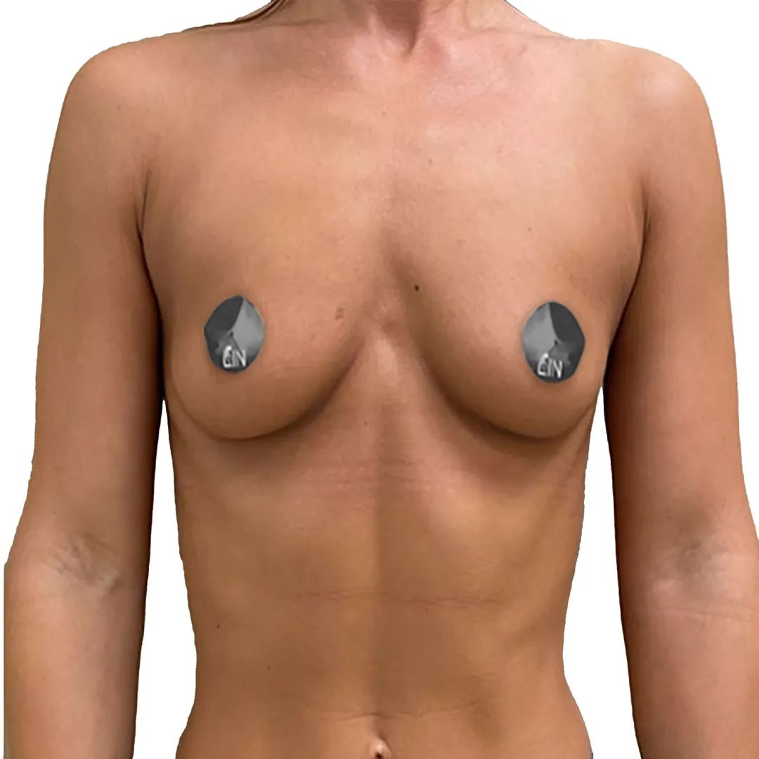Breast Surgery · Front — Before