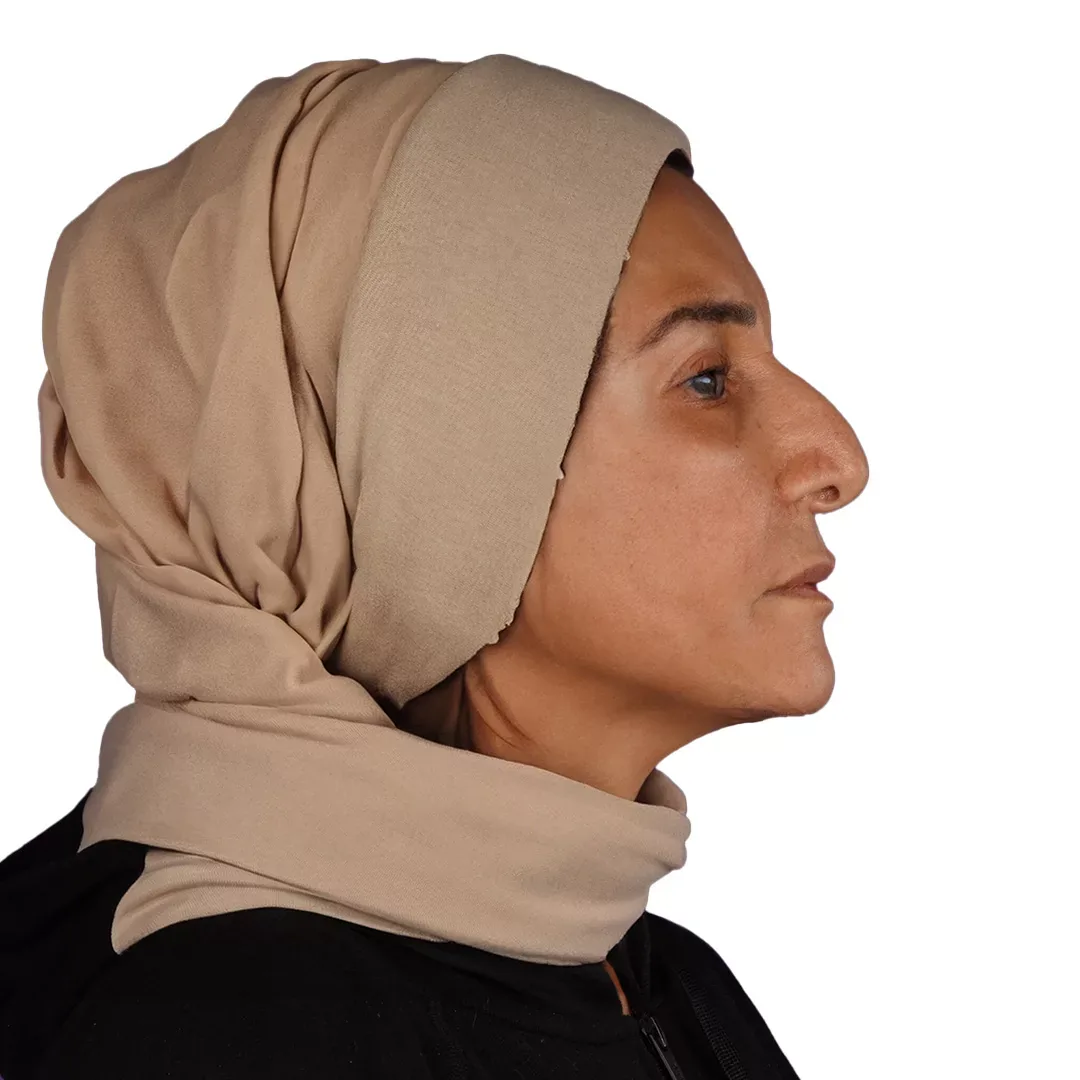 Face & Neck Lift — After