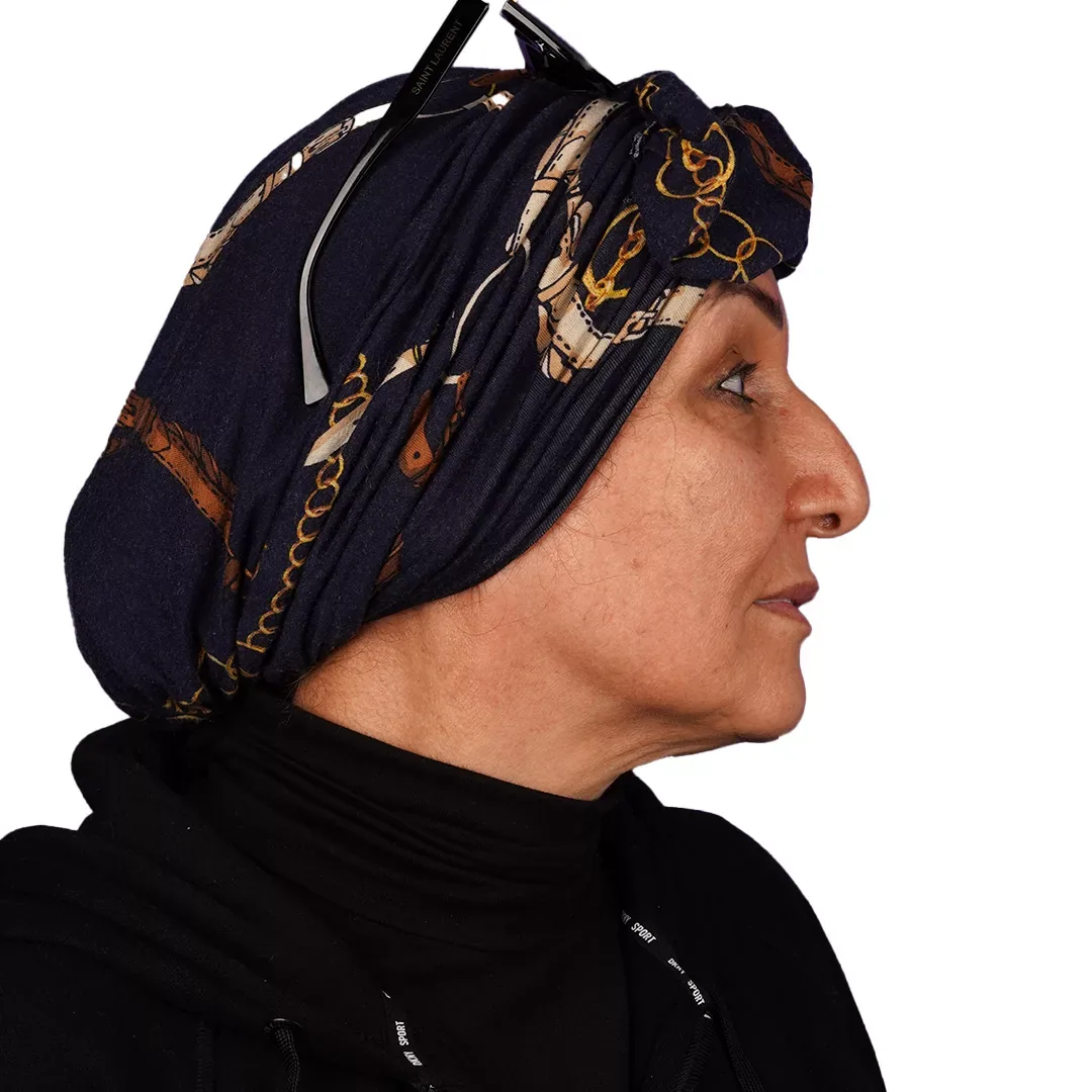 Face & Neck Lift — Before