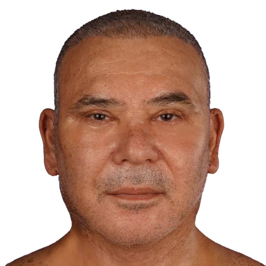 Face & Neck Lift — After