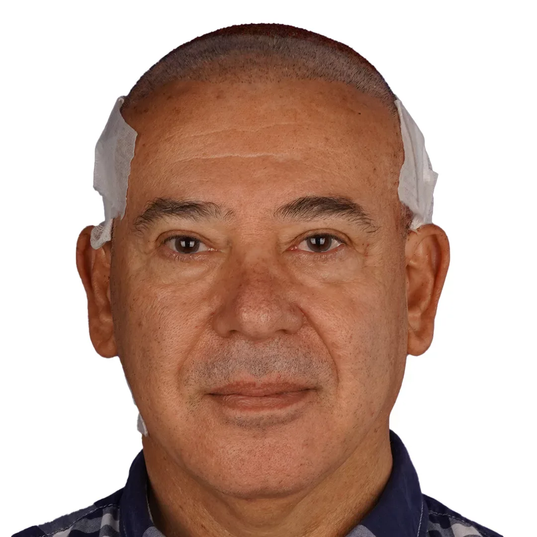 Face & Neck Lift — Before