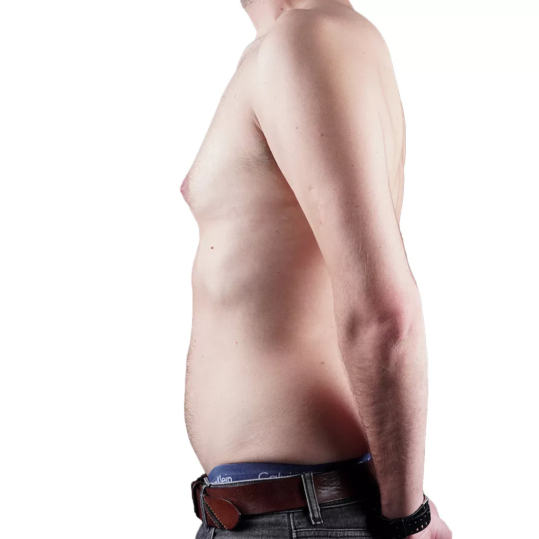 Gynecomastia Surgery — Before