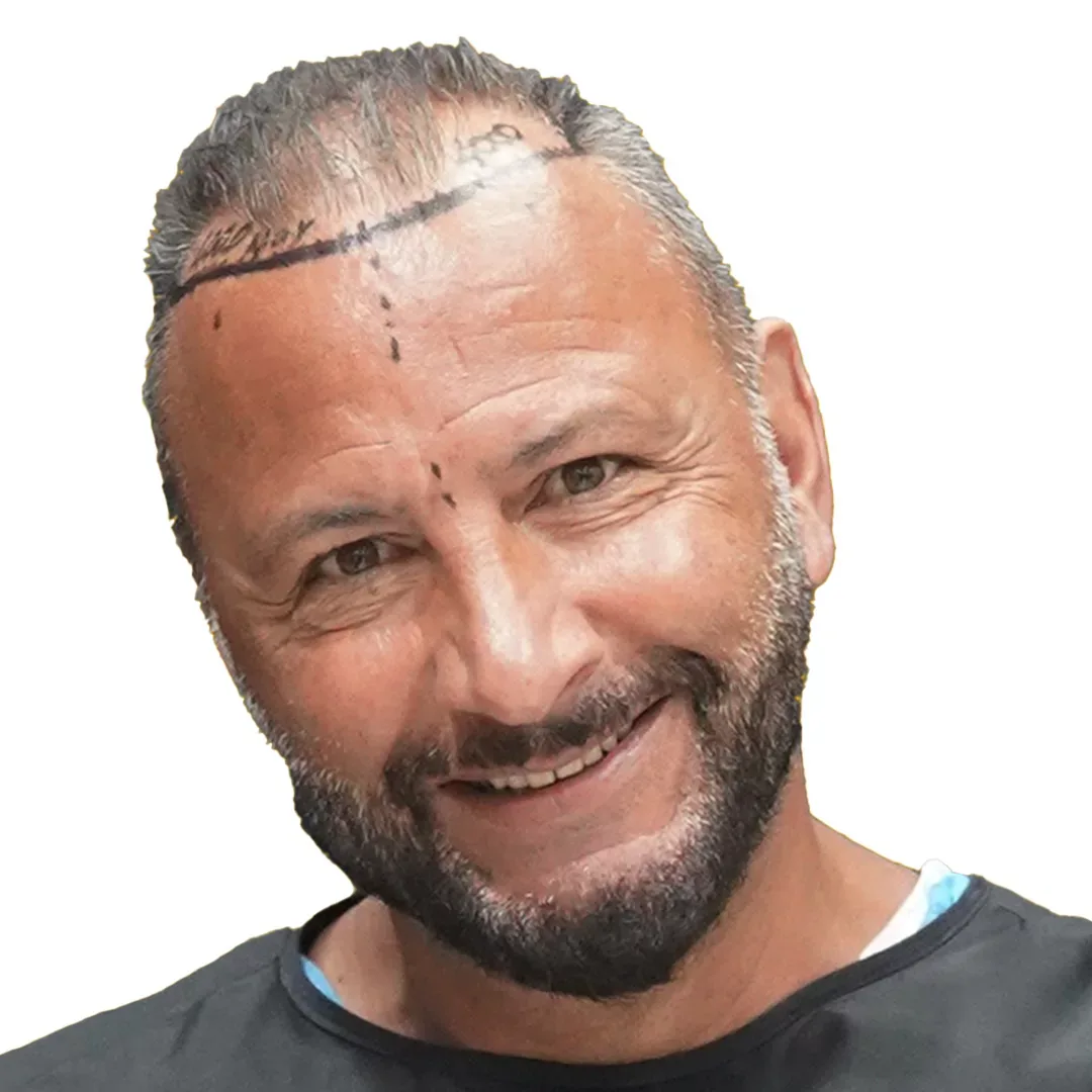 Hair Transplant — Before