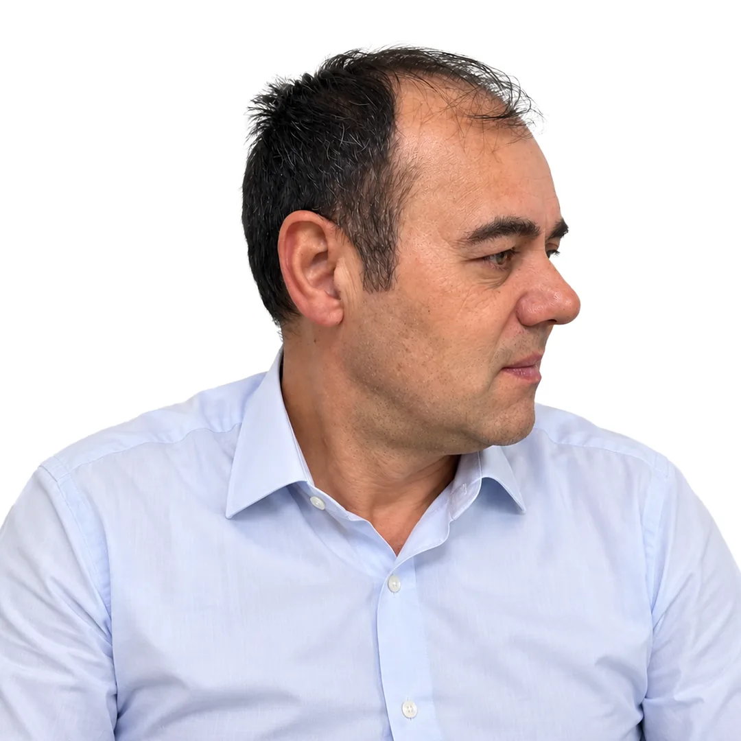 Hair Transplant · Three-quarter — Before