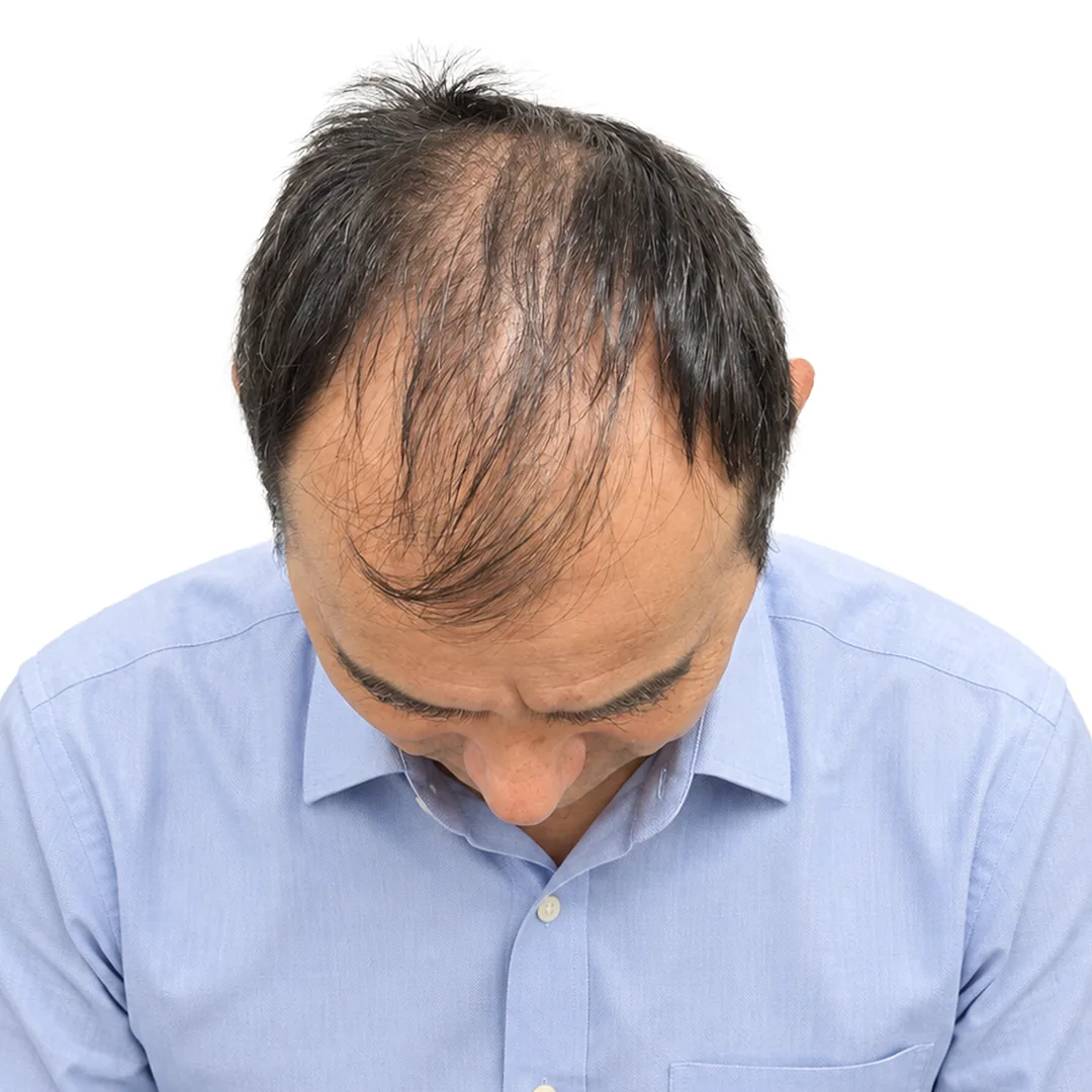 Hair Transplant · Crown — Before