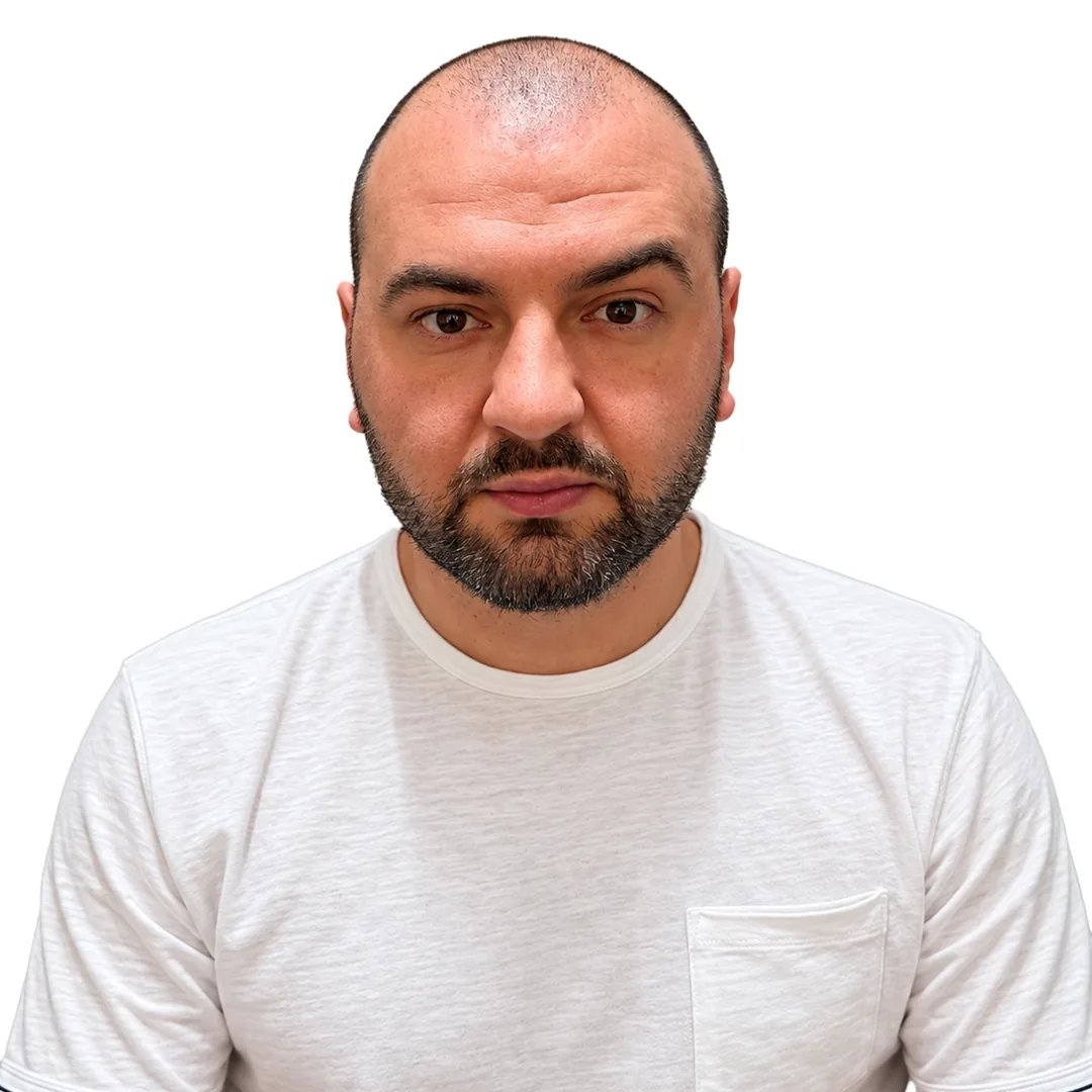 Hair Transplant · Front — Before