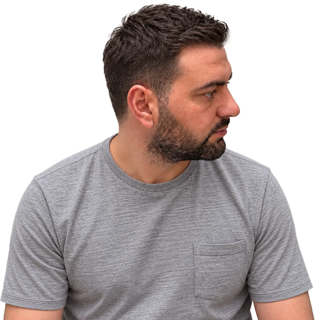 Hair Transplant · Three-quarter — After
