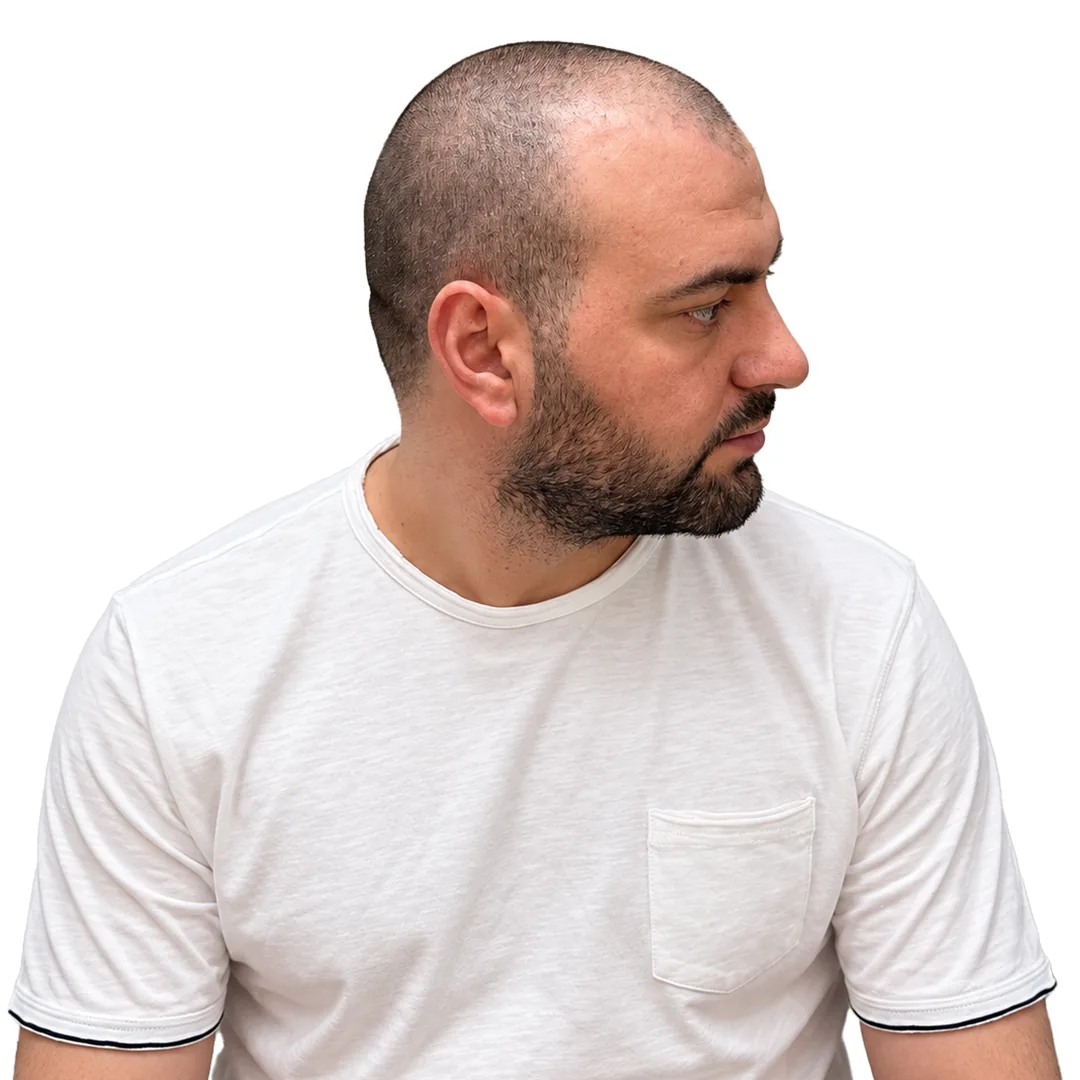 Hair Transplant · Three-quarter — Before