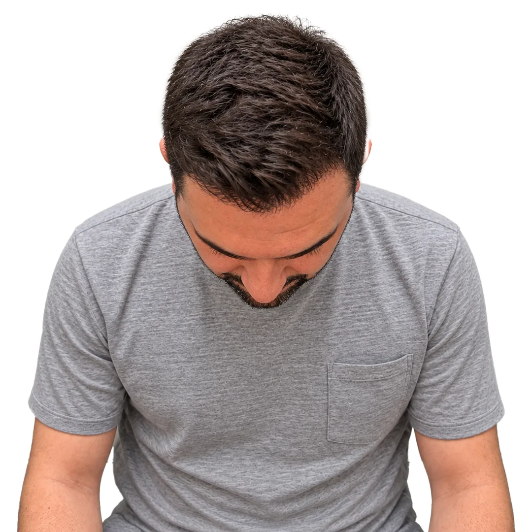 Hair Transplant · Crown — After