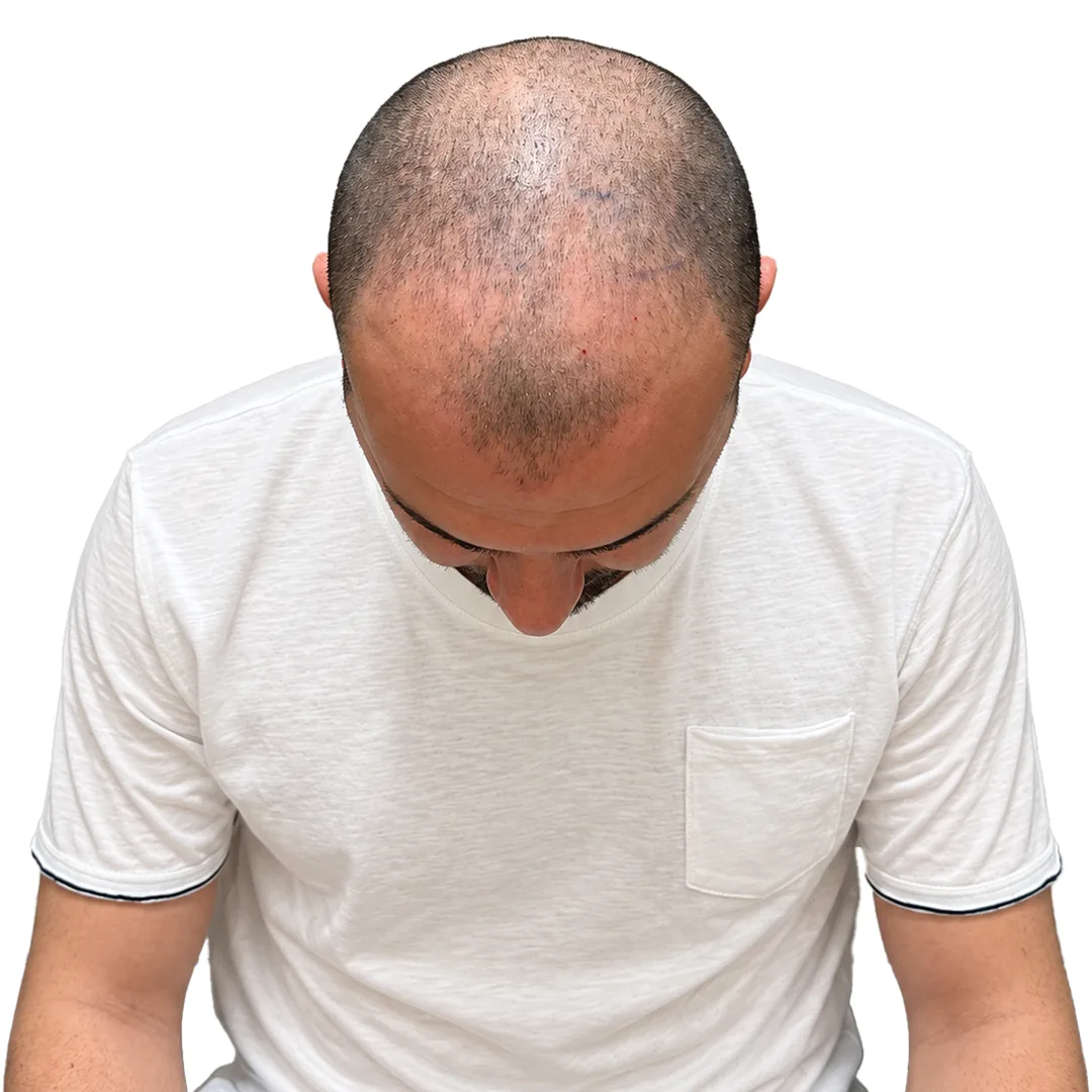Hair Transplant · Crown — Before