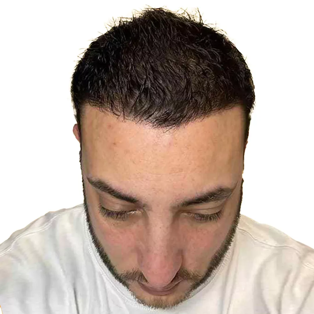Hair Transplant — After