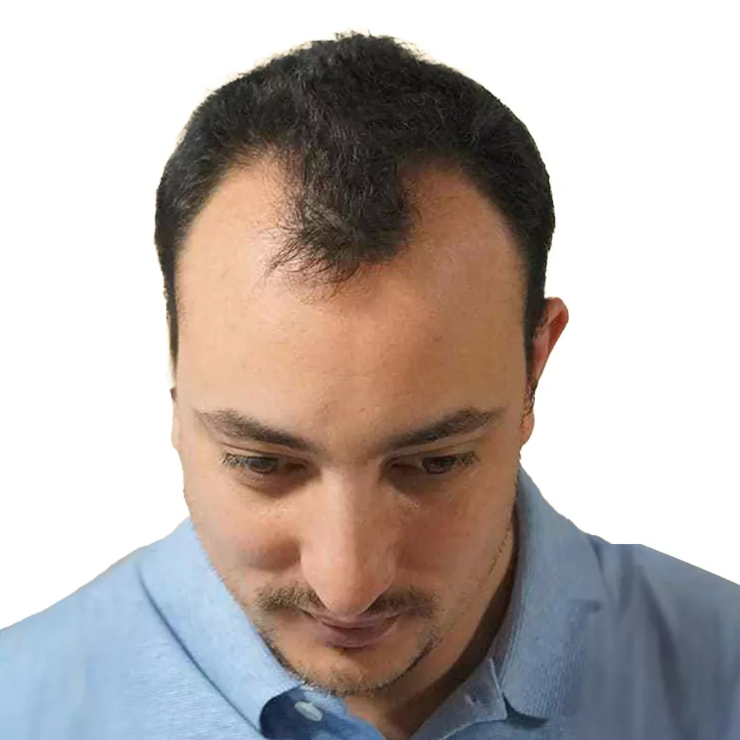 Hair Transplant — Before