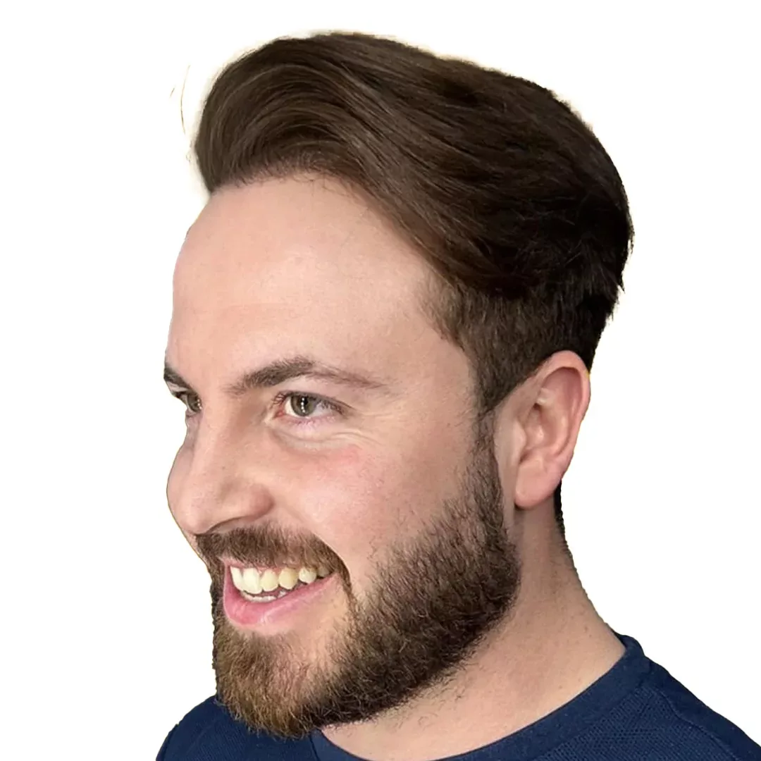 Hair Transplant — After