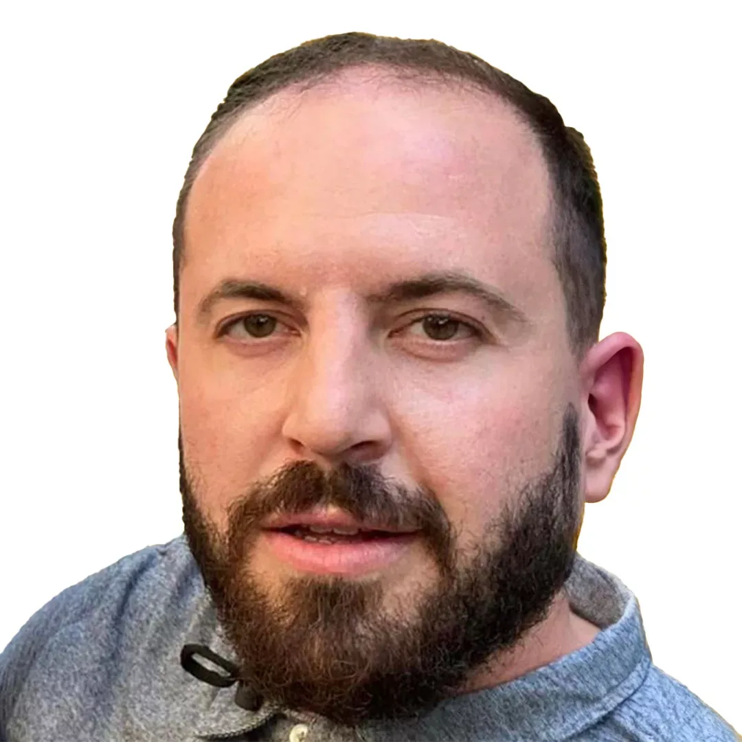 Hair Transplant — Before