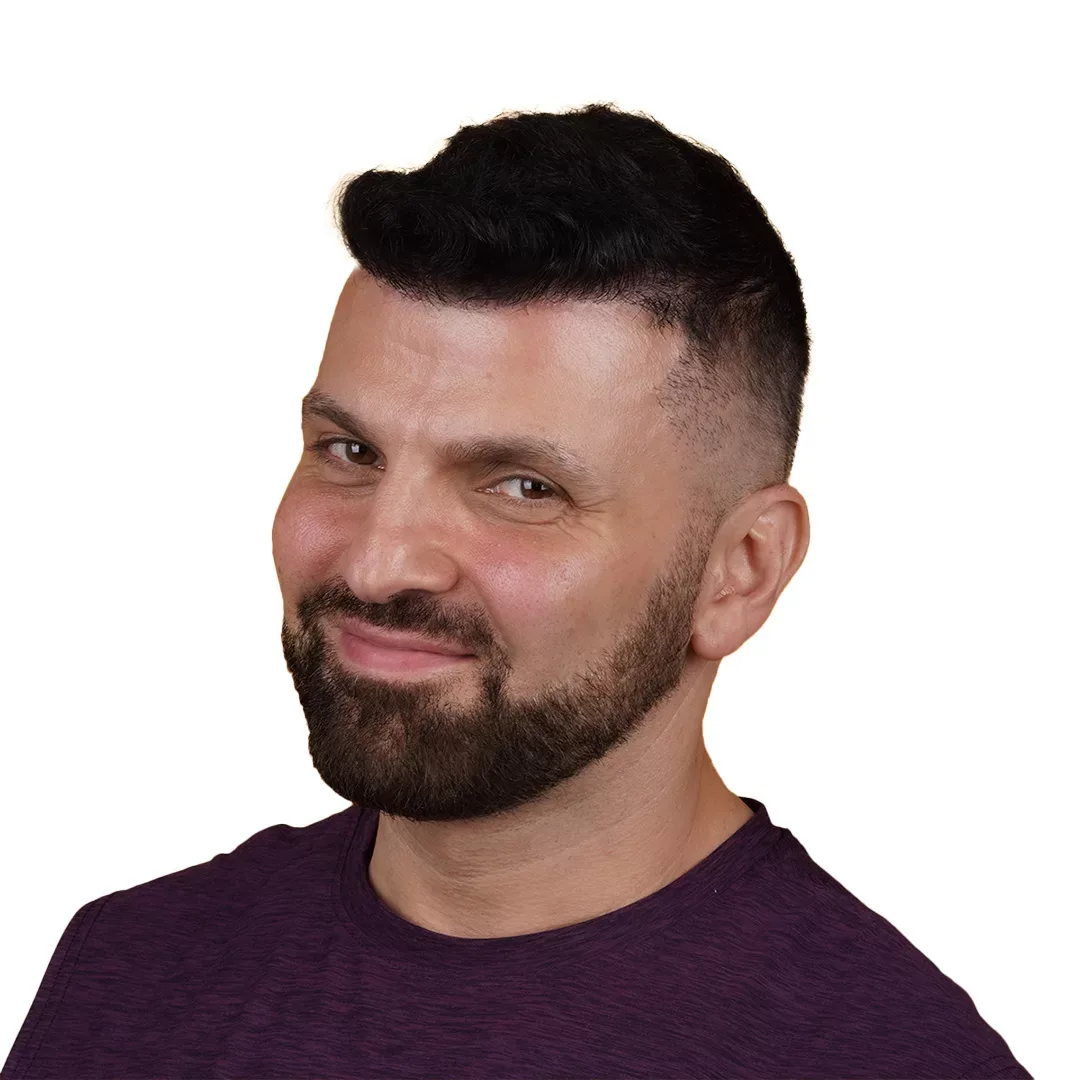 Hair Transplant — After