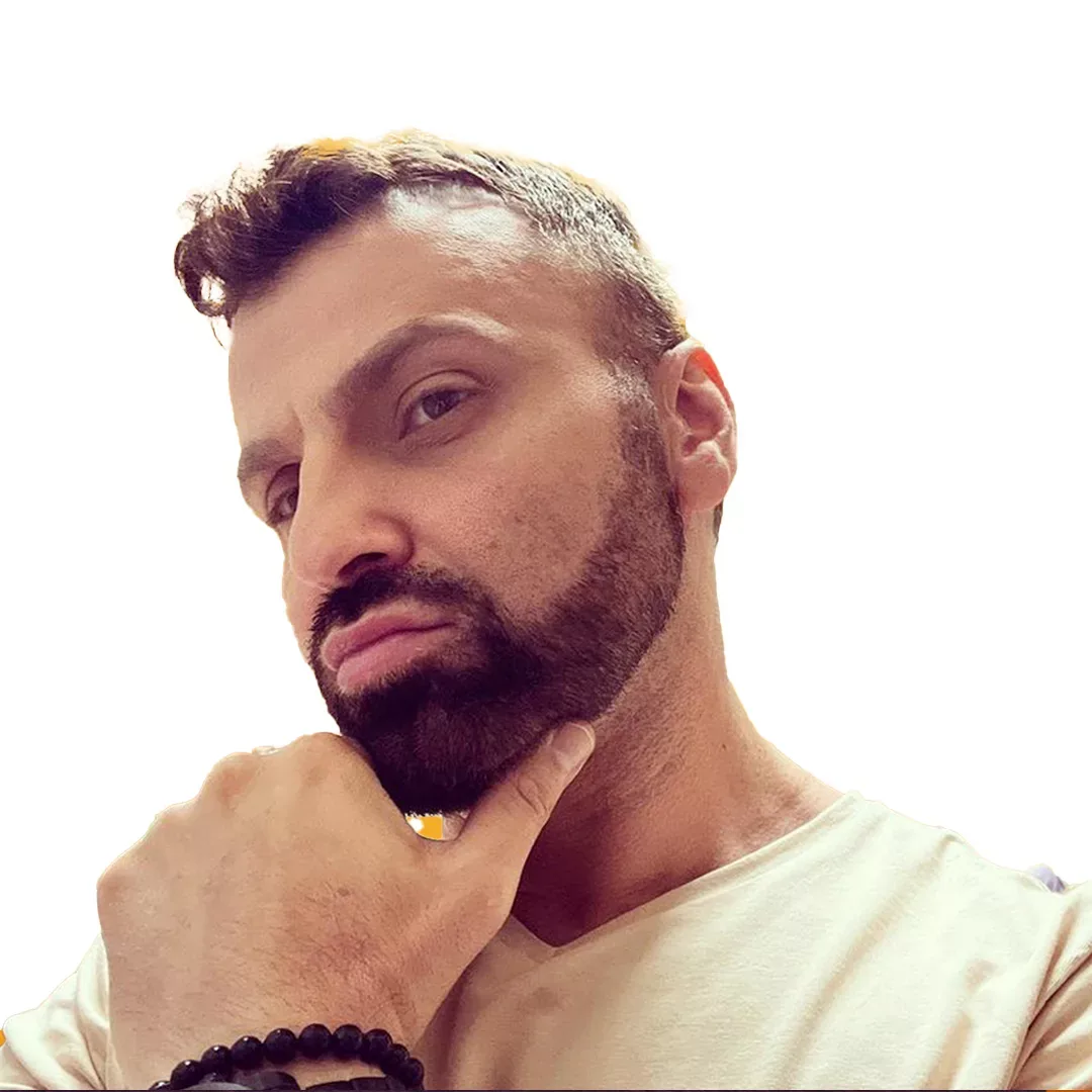 Hair Transplant — Before