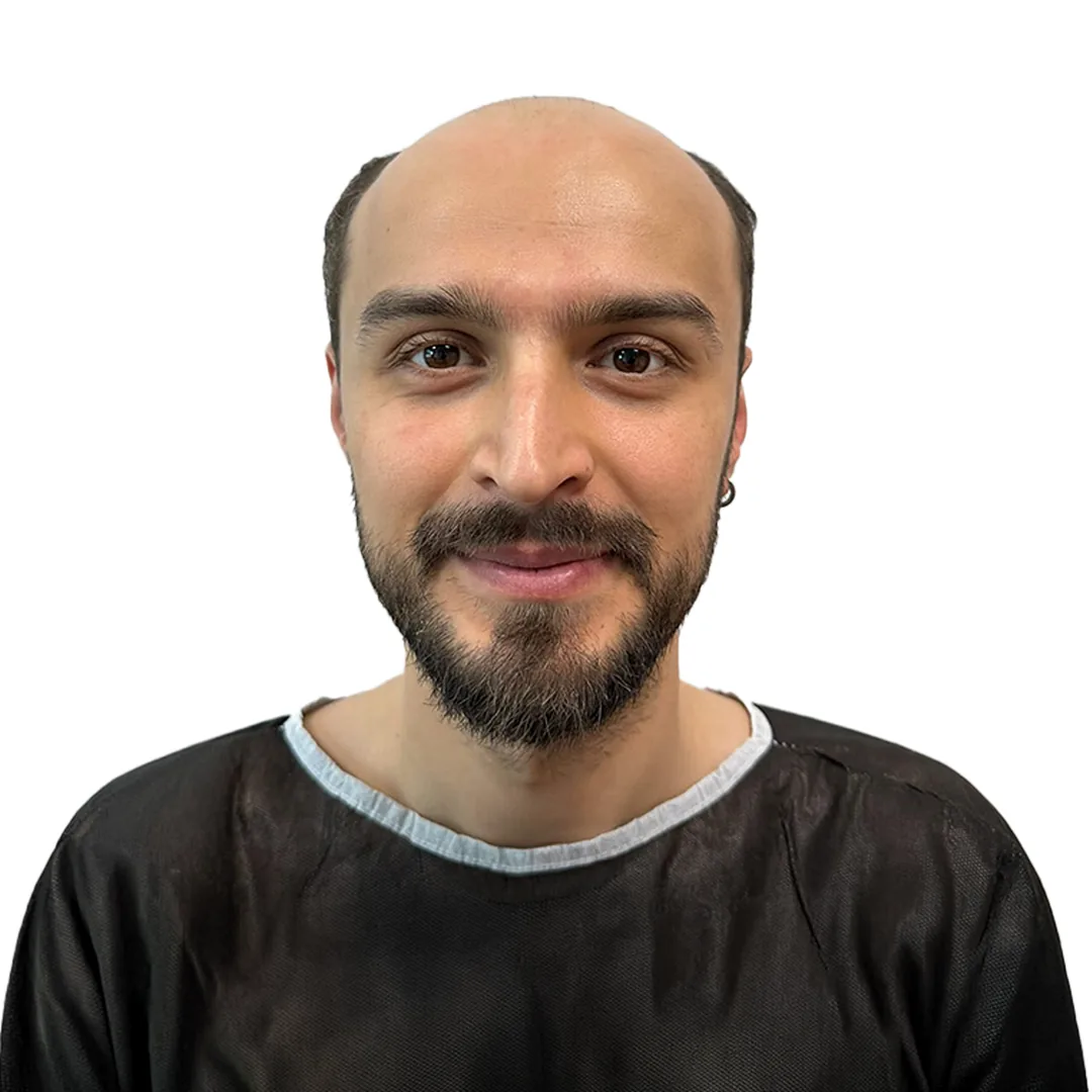 Hair Transplant · Front — Before