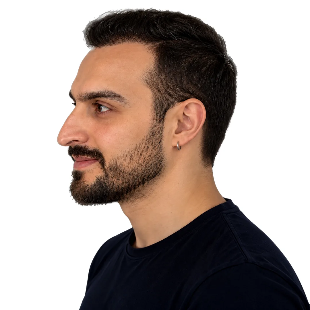 Hair Transplant · Profile — After