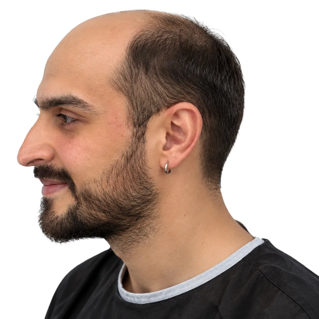 Hair Transplant · Profile — Before