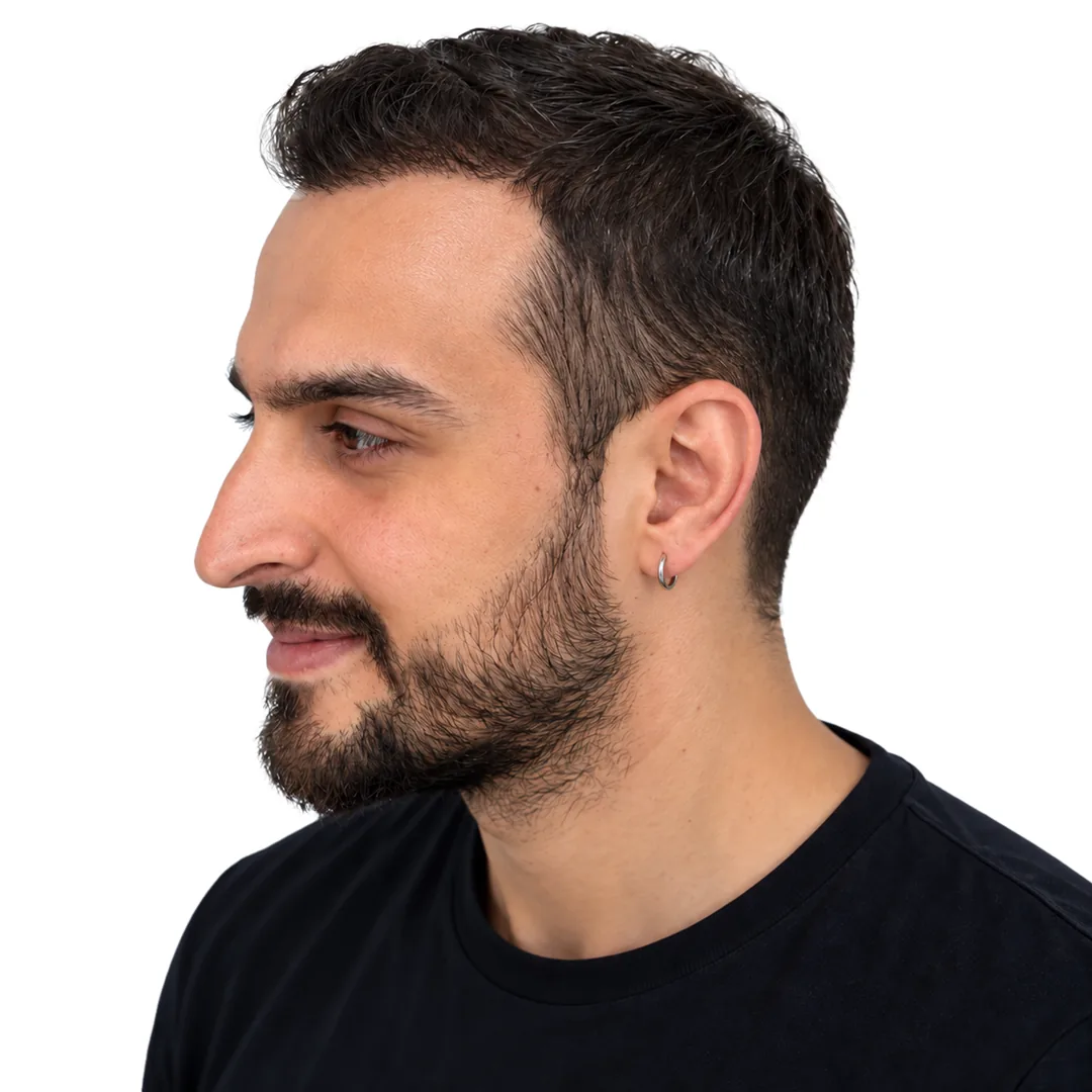 Hair Transplant · Three-quarter — After