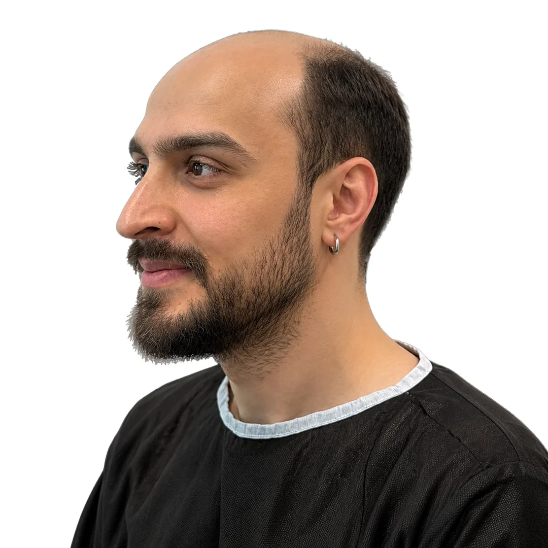 Hair Transplant · Three-quarter — Before
