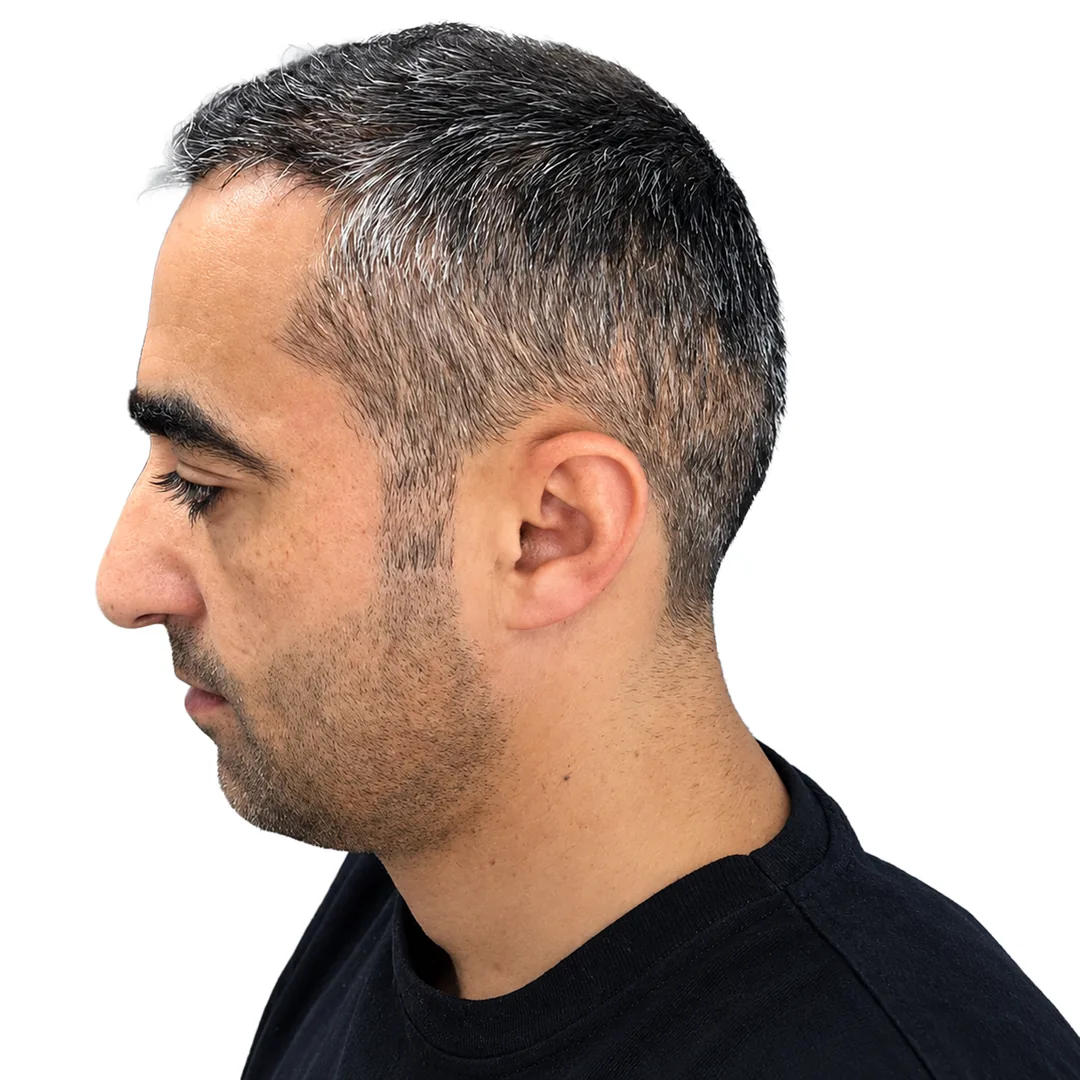 Hair Transplant · Profile — After