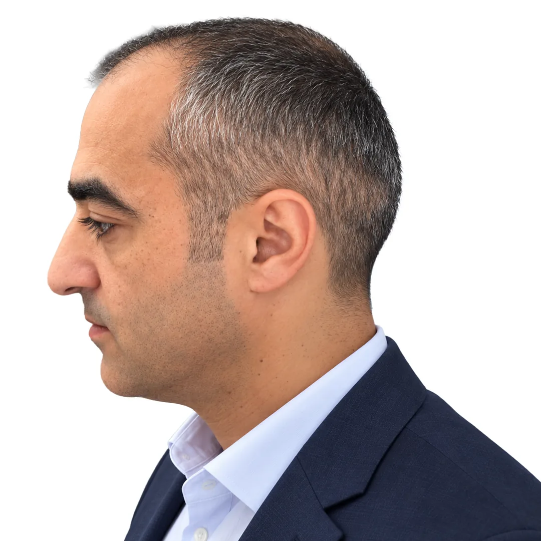 Hair Transplant · Profile — Before