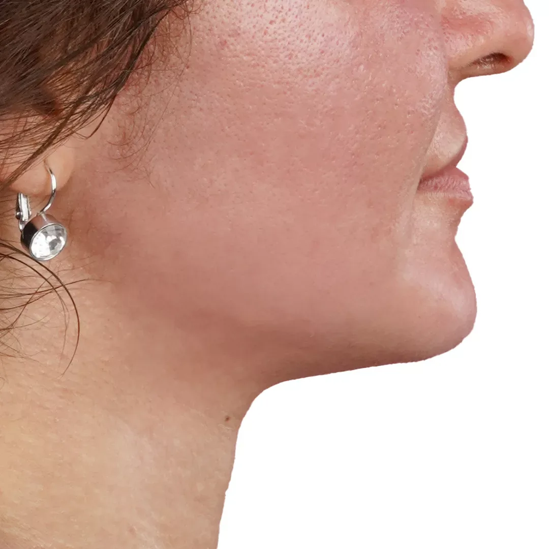 Jawline Contouring — After
