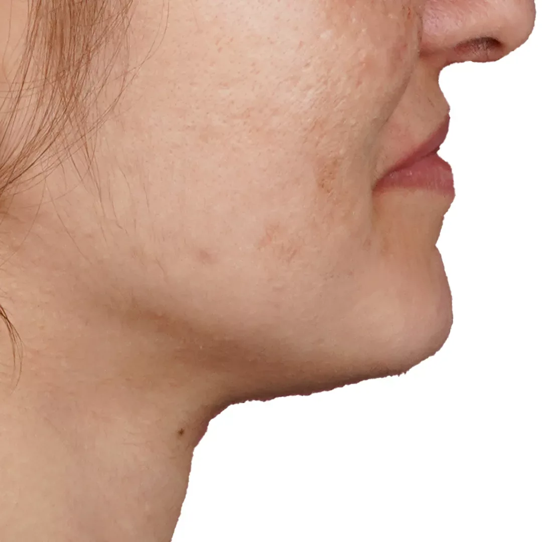 Jawline Contouring — Before