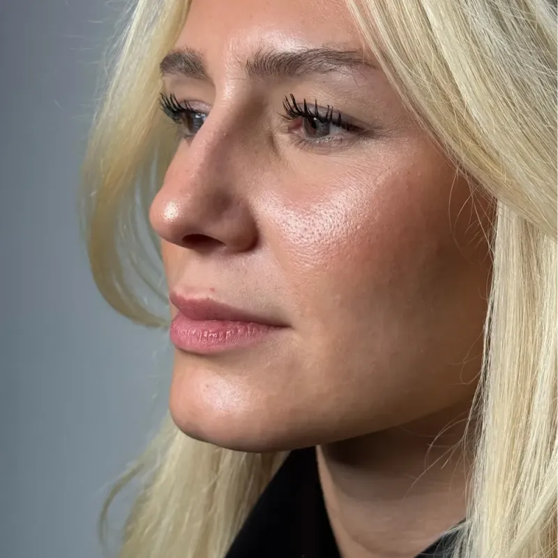 Lip Filler — Before