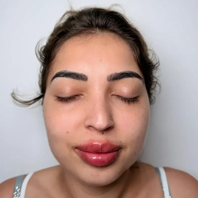 Lip Filler · Front — After