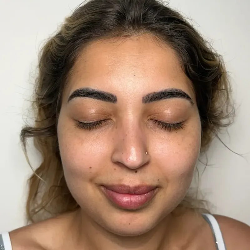 Lip Filler · Front — Before