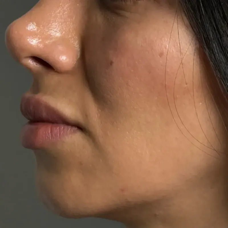 Lip Filler · Profile — Before