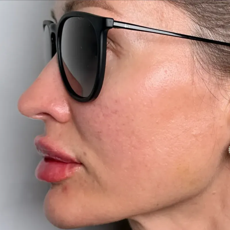 Lip Filler · Side — After