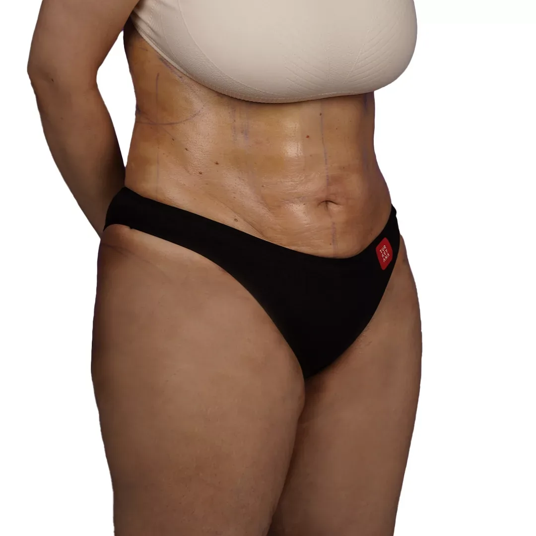 Liposuction — After