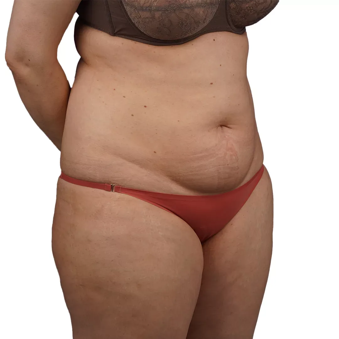 Liposuction — Before