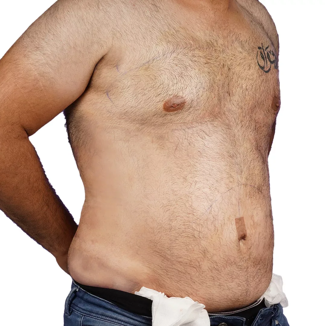Liposuction — After