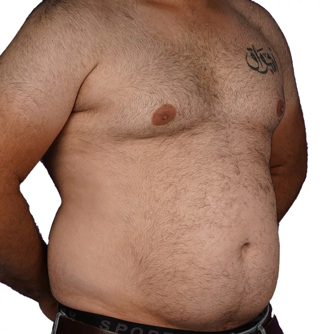 Liposuction — Before