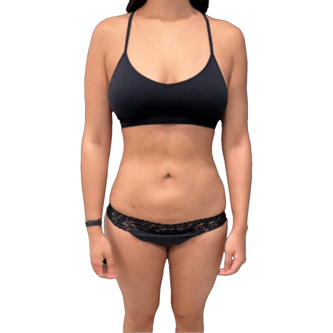 Liposuction · Front — Після