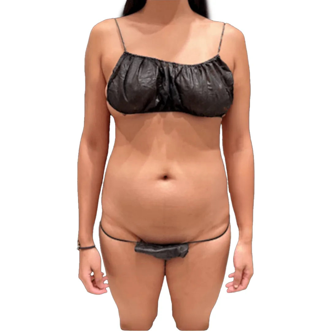 Liposuction · Front — До