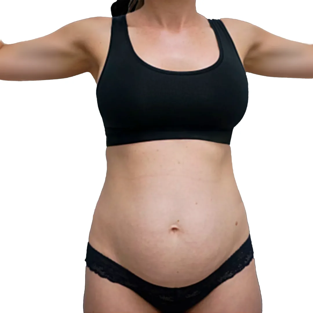 Liposuction · Front — До