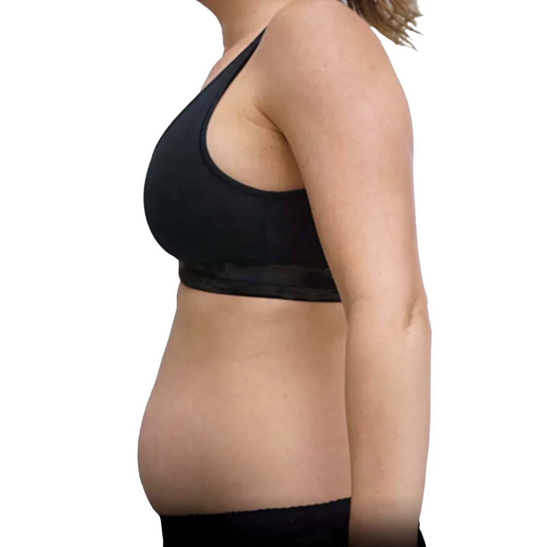 Liposuction · Side — До